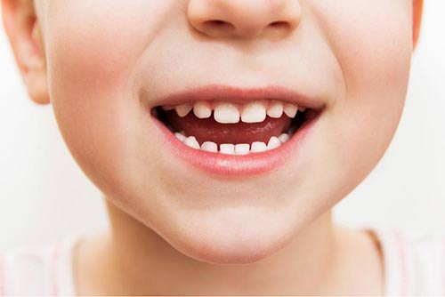 Pediatric White Crowns • Amesbury, MA • Riverside Pediatric Dentistry